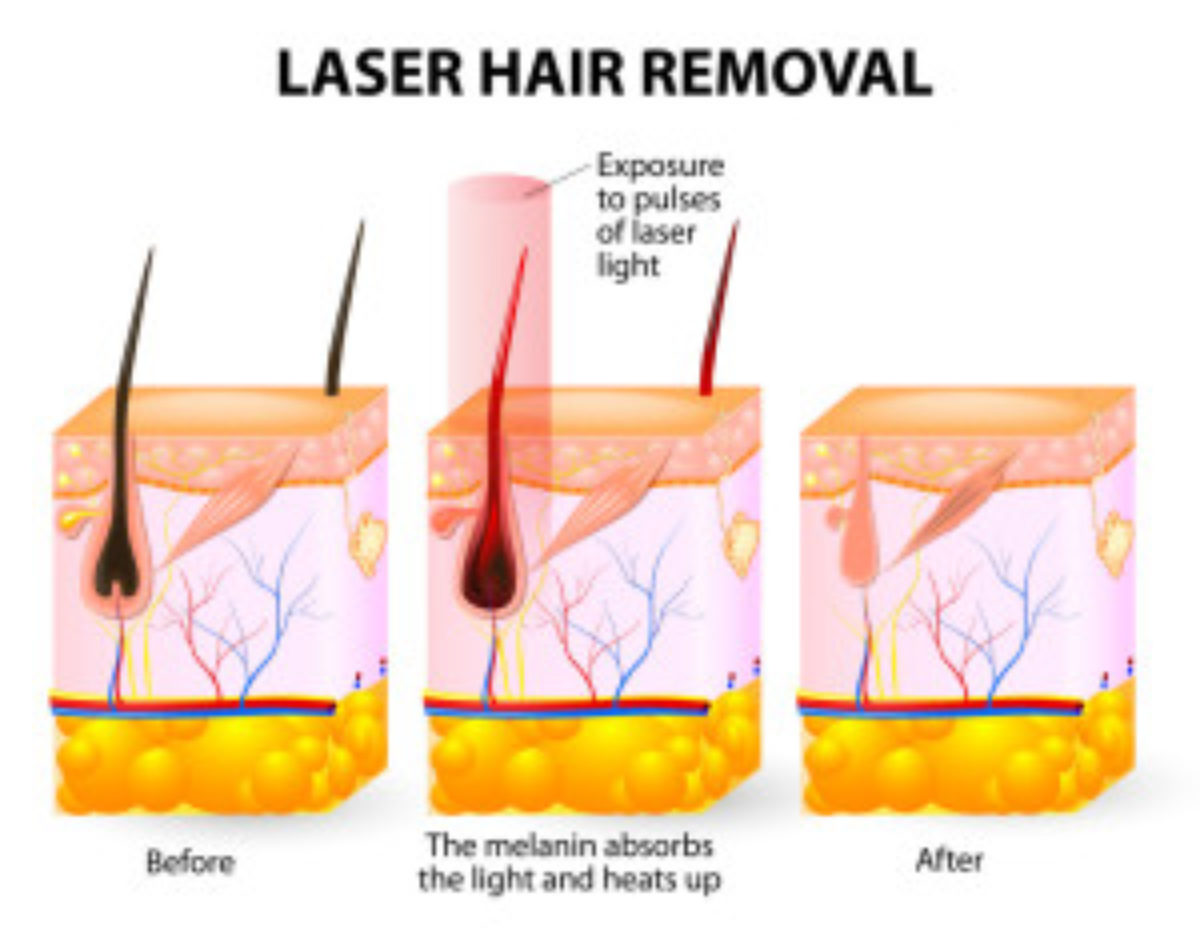 Laser Hair Removal in Plano TX Offers Incredible Benefits