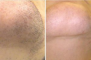 , Laser Hair Removal