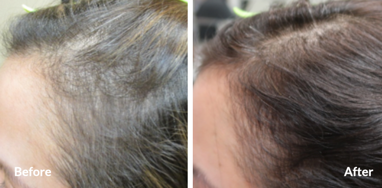 PRP Hair Restoration Frisco TX - Le Beau Visage Medical Spa