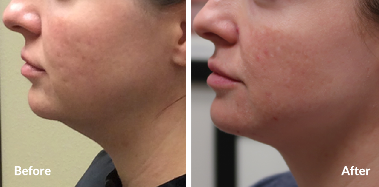 Kybella Double Chin Reducation TX