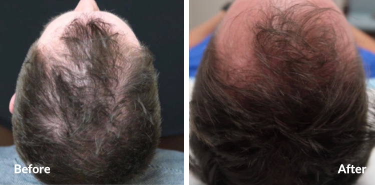 PRP Hair Restoration, PRP Hair Restoration
