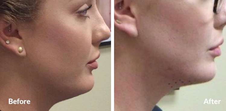 Kybella Double Chin Reducation TX