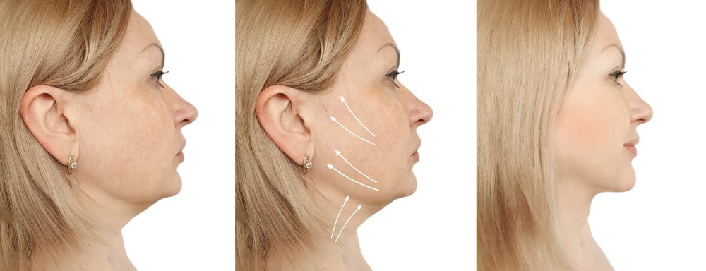 Best non-surgical treatments for face contouring - Hush LA Medspa