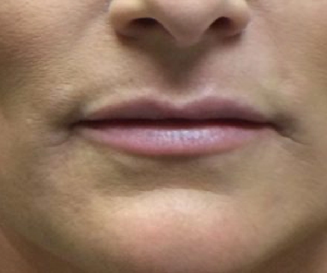 Botox (1)