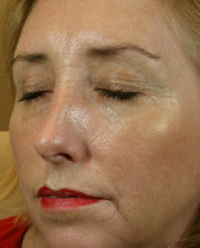 Botox (2)
