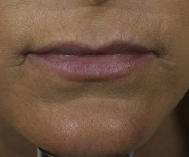 Botox (3)