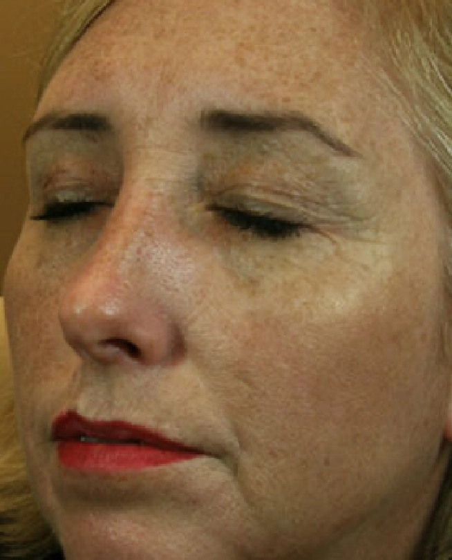 Botox (4)