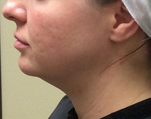 Kybella & Mesotherapy case #3812