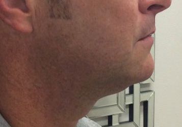 Kybella & Mesotherapy case #3806