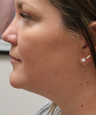 Kybella & Mesotherapy case #3815