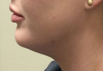 Kybella & Mesotherapy case #3809