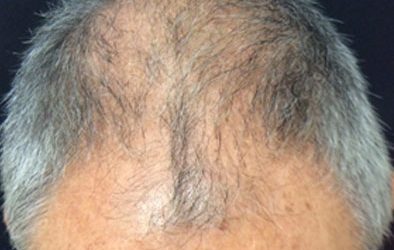 PRP for Hair Restoration case #3879