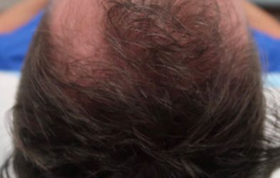 PRP for Hair Restoration case #3873