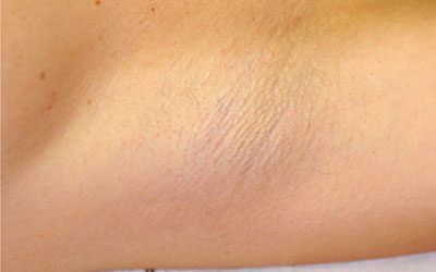 Laser Hair Removal case #3827