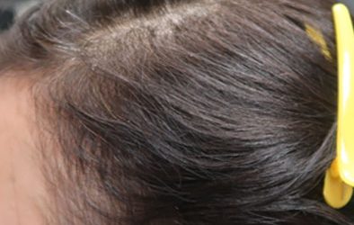 PRP for Hair Restoration case #3890