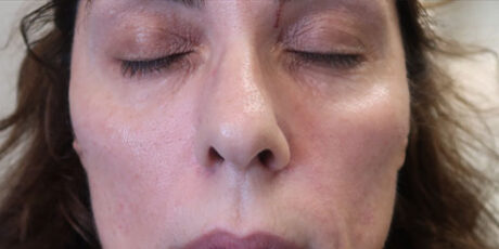 Cheek Filler case #3689