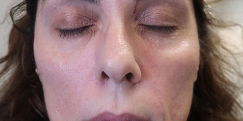 Cheek Filler case #3689