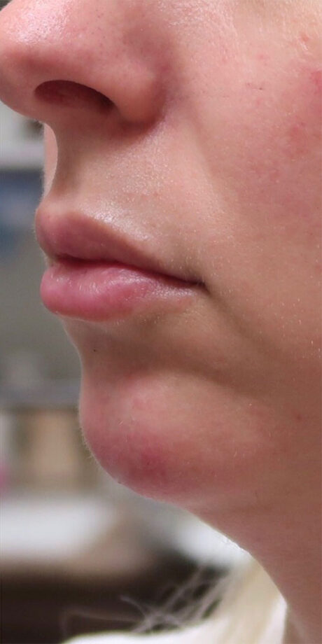 Chin Filler case #3698