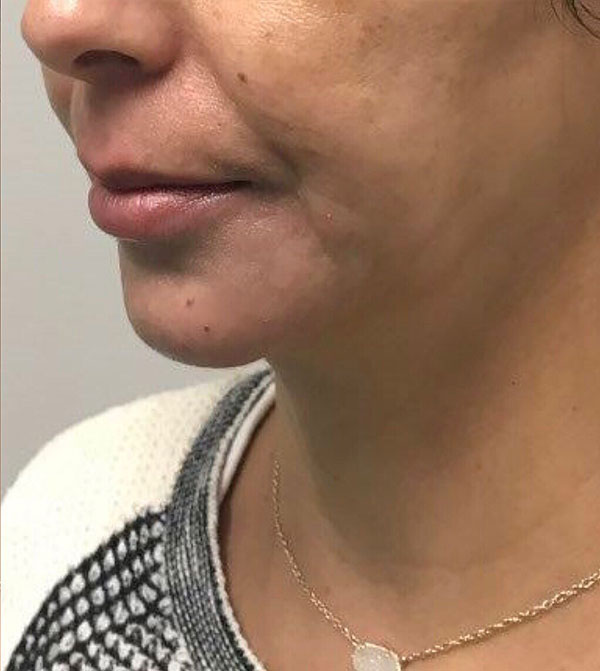 Chin Filler case #3701