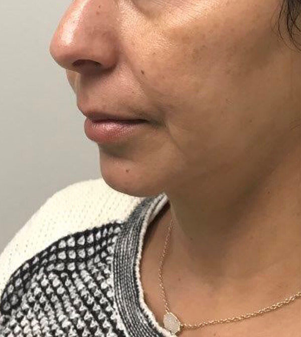 Chin Filler case #3701