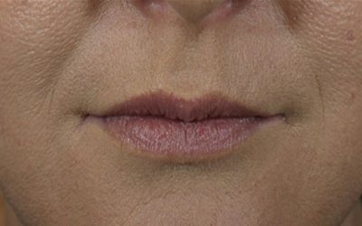 Lip Filler case #3740