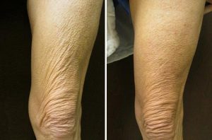 Skin Resurfacing case #4709