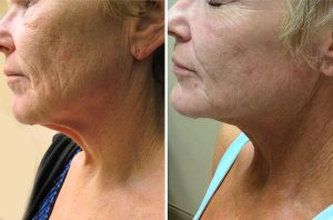 Skin Resurfacing case #4715