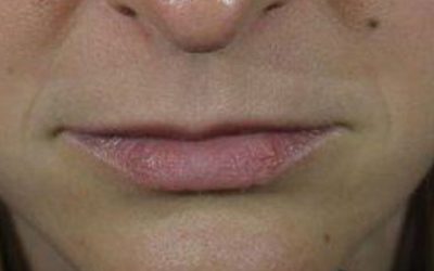 Lip Filler case #3713