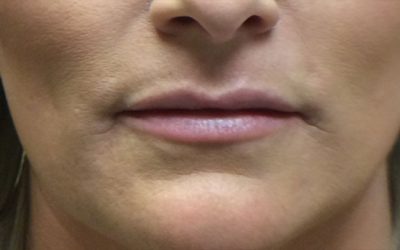 Lip Filler case #3734