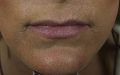 Lip Filler case #3734