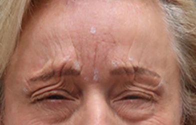 Neurotoxin - BOTOX® & Dysport case #3849