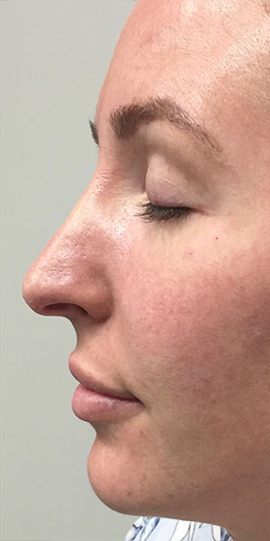 Liquid Rhinoplasty case #3755