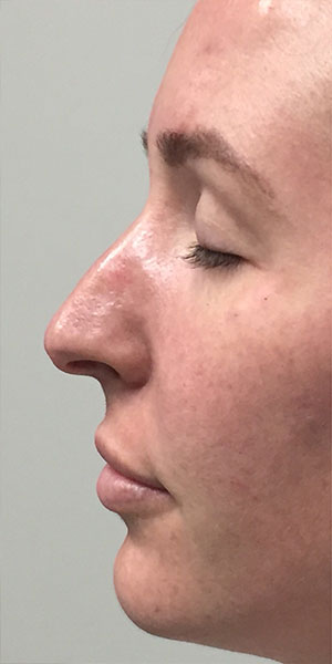 Liquid Rhinoplasty case #3755