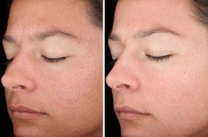 Skin Resurfacing case #4717