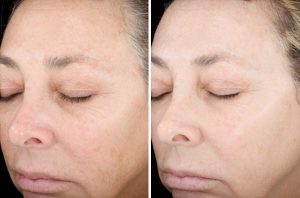 Skin Resurfacing case #4719