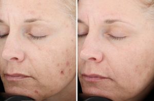 Skin Resurfacing case #4721