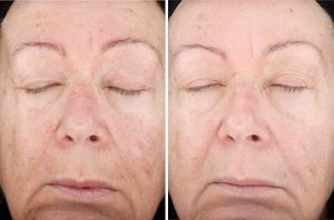 Skin Resurfacing case #4727