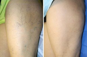 Vein Reduction case #4695