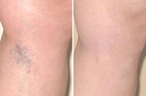 Vein Reduction case #4697