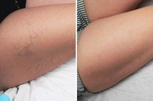 Vein Reduction case #4699