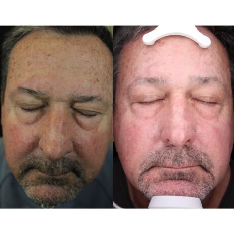 IPL Photofacial case #5161