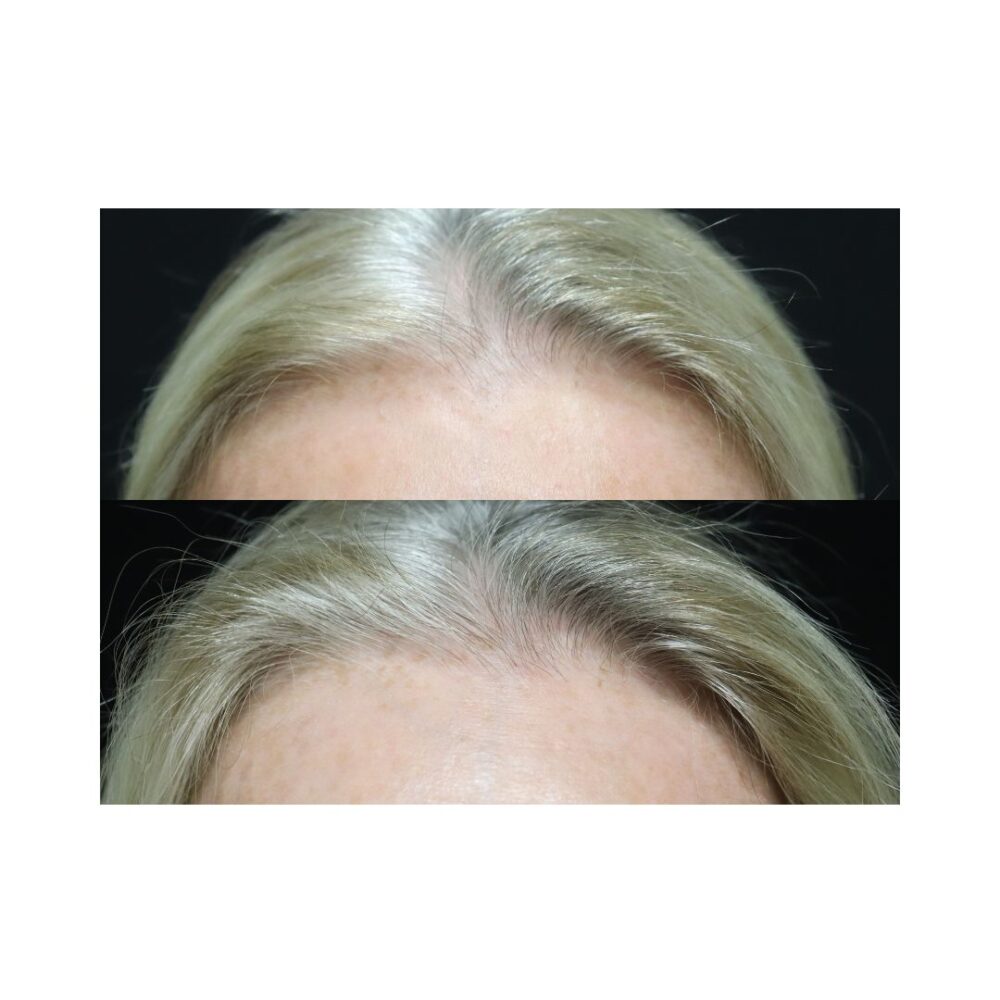 Hair Transplant case #5166