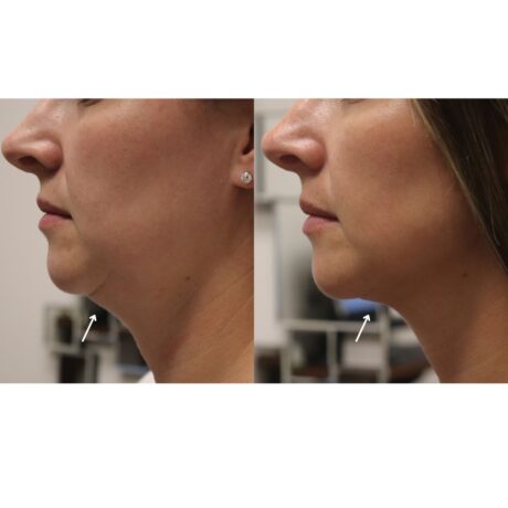 Mesotherapy case #5116