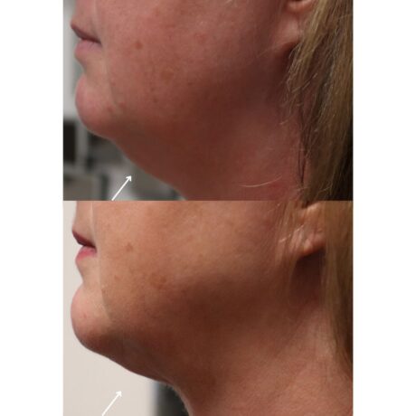 Mesotherapy case #5114