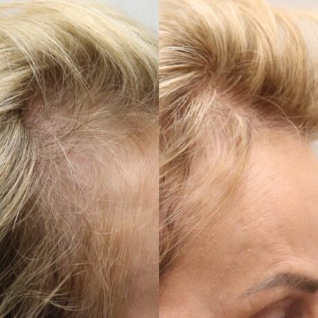 PRP for Hair Restoration case #5038