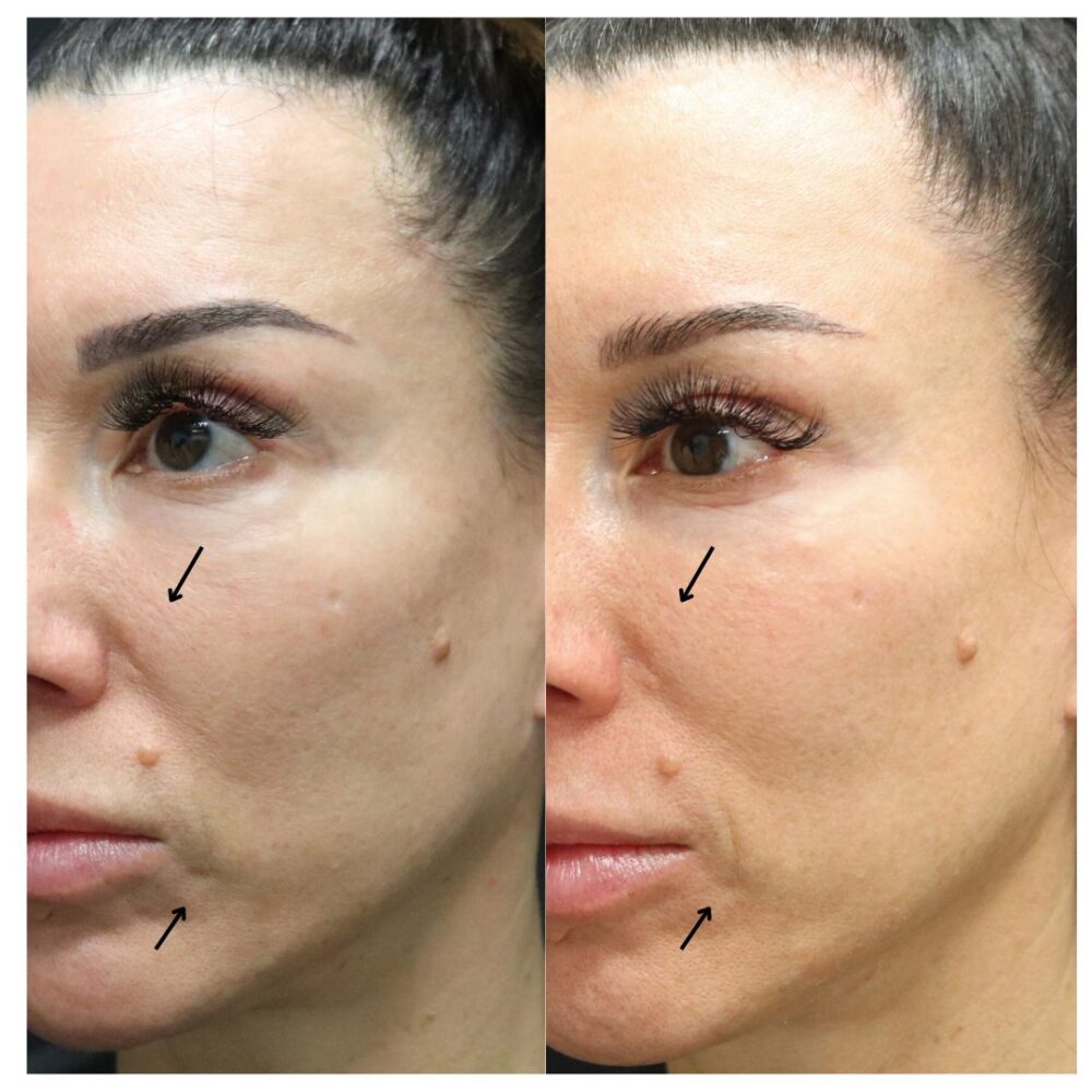 DermaFrac case #4901