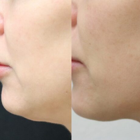 Mesotherapy case #5110