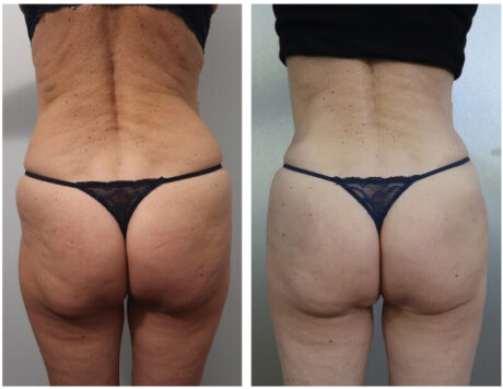 Non-Surgical Butt Lift case #5240