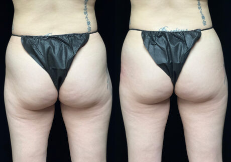 Non-Surgical Butt Lift case #5244