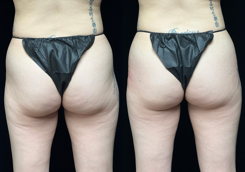 Non-Surgical Butt Lift case #5244